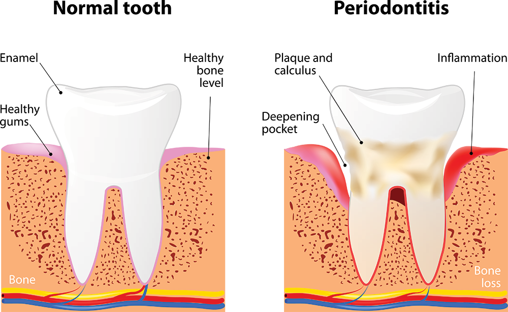 Tooth graphic showing periodontal risk